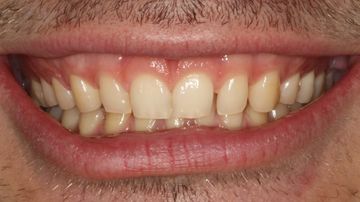 Picture of teeth after veneers