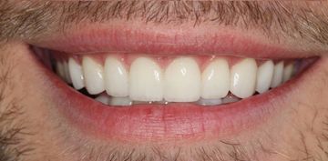 Picture of teeth after veneers